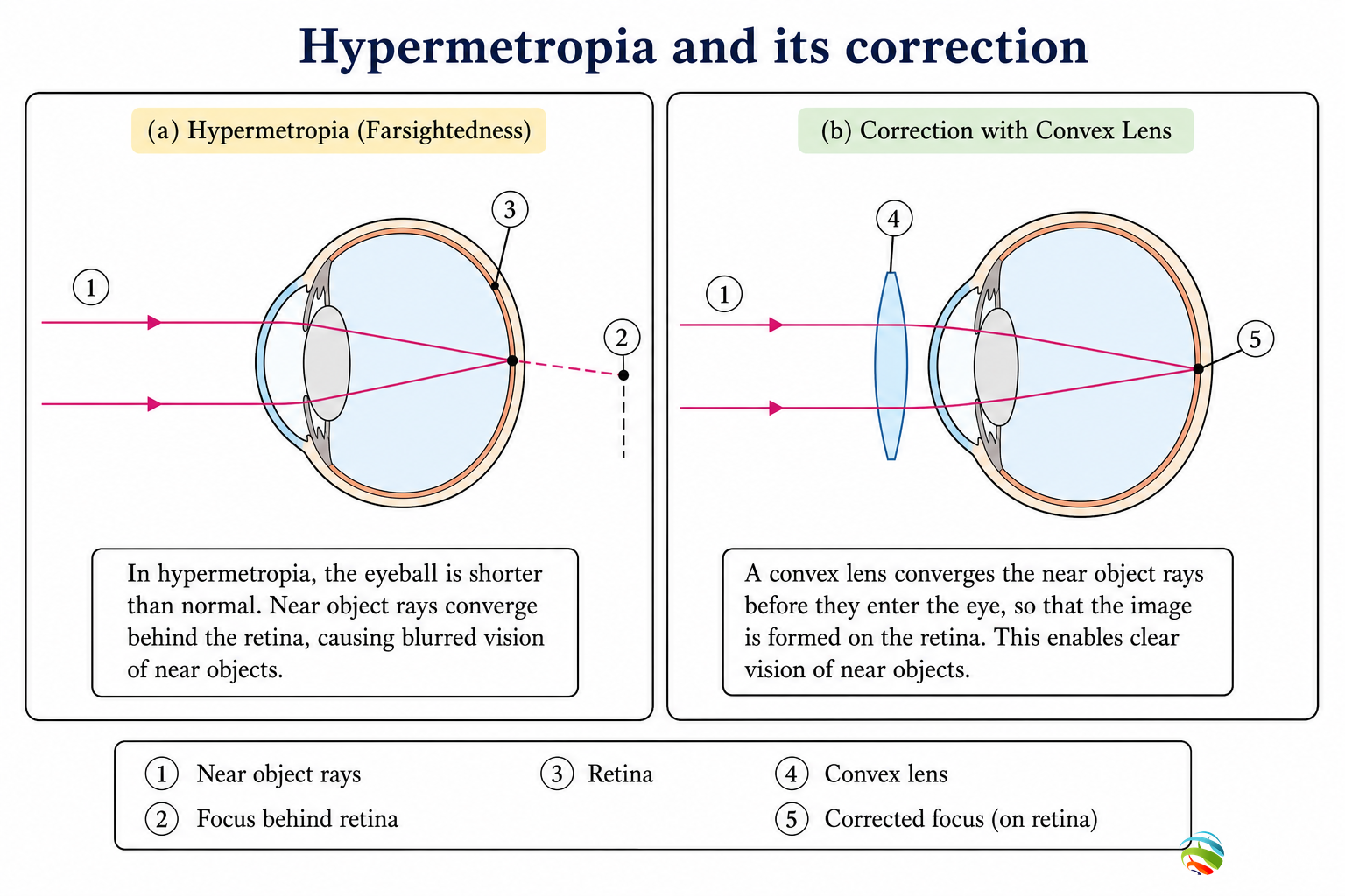 Hypermetropia and correction