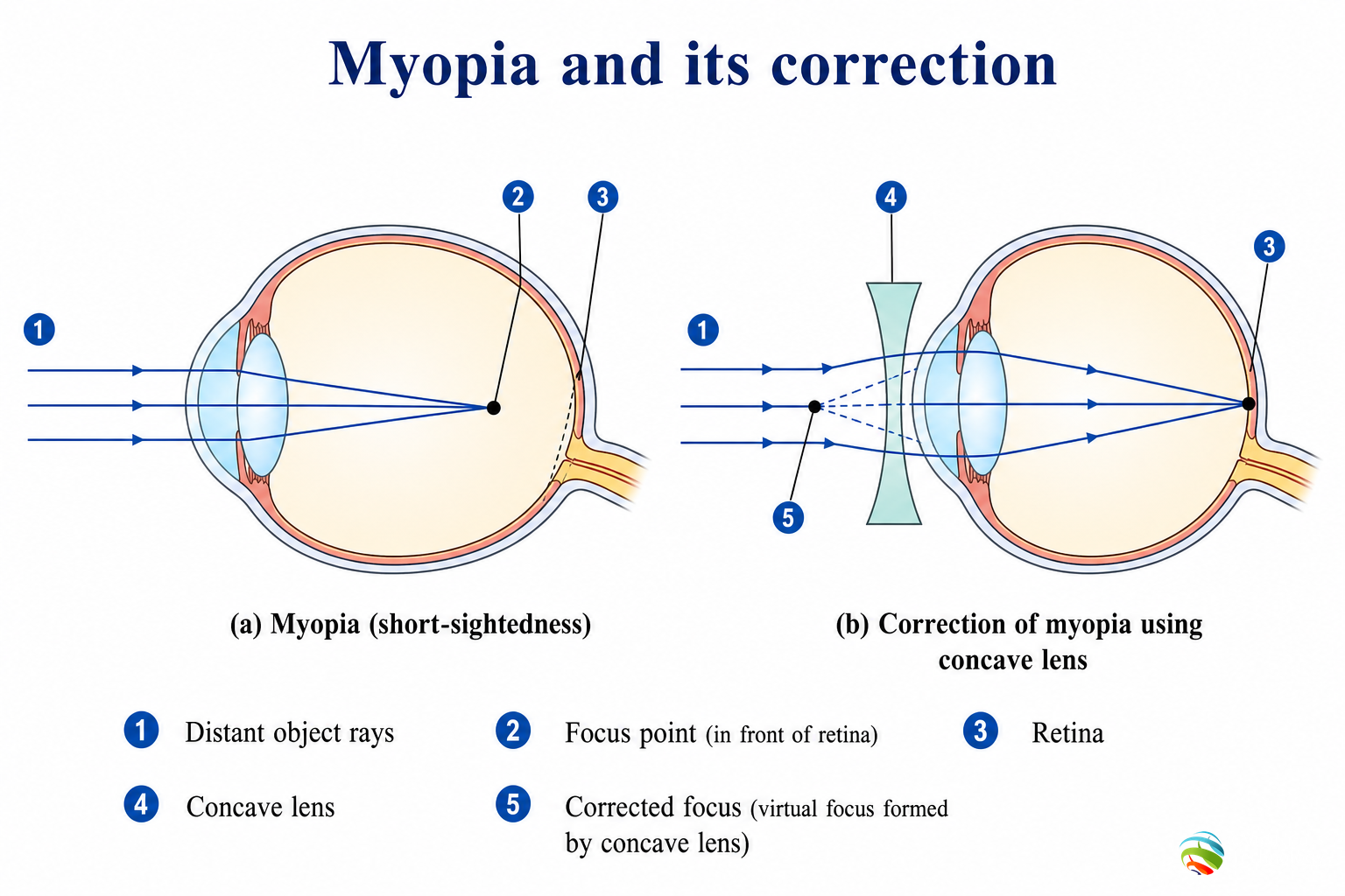 Myopia and correction